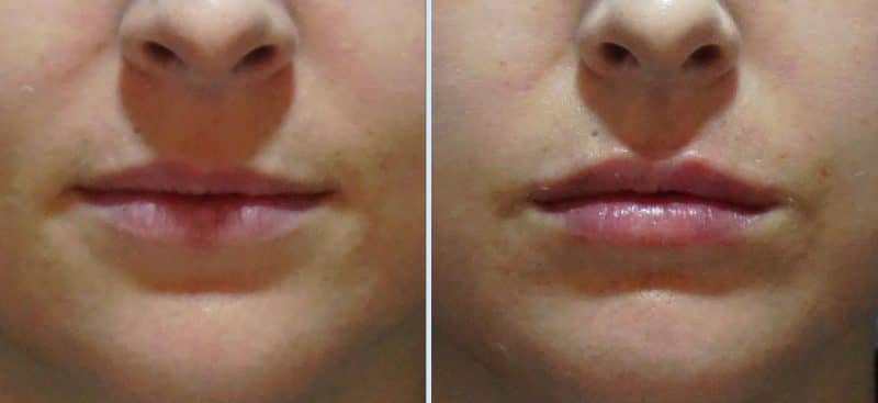 Fill’er Up: Lip Fillers at MH Clinic, Seoul with Eunogo