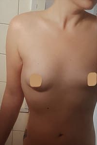 Boob Job in Seoul Korea Before and After Breast Augmentation Plastic Surgery Before and After