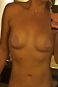 Boob Job in Seoul Korea Before and After Breast Augmentation Plastic Surgery Before and After